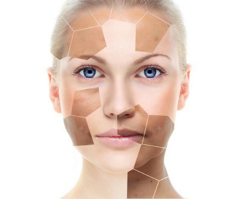 Leia mais sobre o artigo Por que é tão DIFÍCIL tratar o MELASMA ?