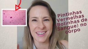 Leia mais sobre o artigo Pintinhas Vermelhas (Bolinhas de Sangue) no Corpo