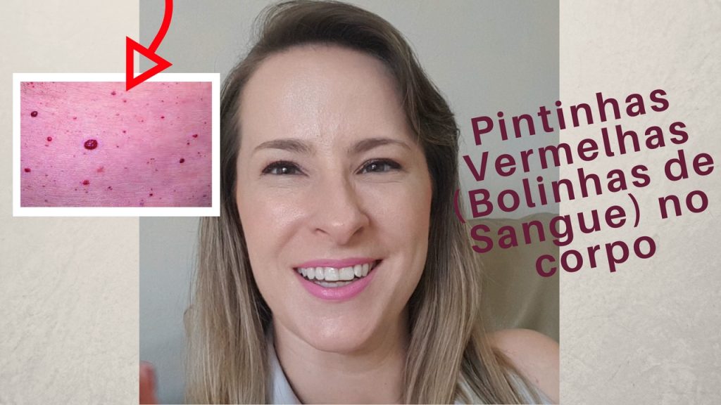 Leia mais sobre o artigo Pintinhas Vermelhas (Bolinhas de Sangue) no Corpo