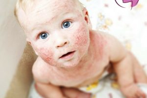 Dermatite Atópica : 4 Dicas para ACABAR com essa alergia