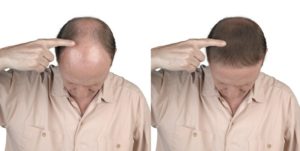 tratamento para queda de cabelo antes e depois
